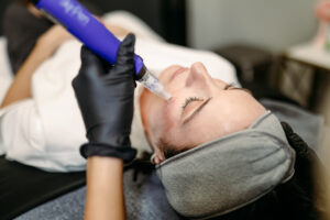 skinpen microneedling